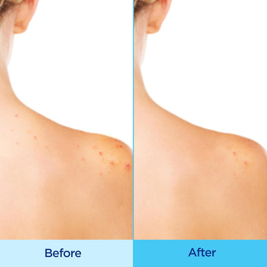 Differin Acne Body Spray- Acne Treatment with Salicylic Acid 170g