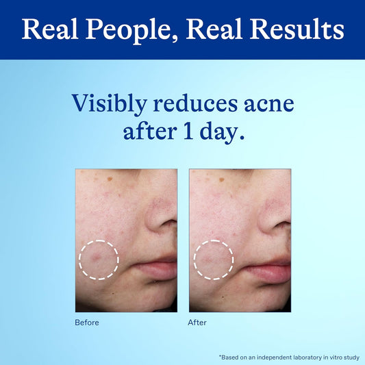 Differin Acne Spot Treatment with 10% Benzoyl Peroxide, Maximum Strength 28g