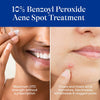 Differin Acne Spot Treatment with 10% Benzoyl Peroxide, Maximum Strength 28g