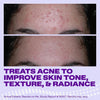 Differin Epiduo Acne Gel Treatment, Adapalene & Benzoyl Peroxide 15g Pump